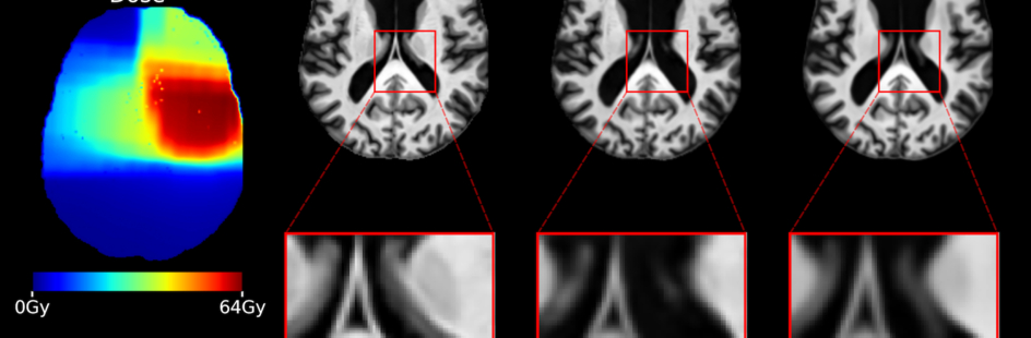 Figuur toont MRI-scan, dosis radiotherapie en afbeeldingen die laten zien hoe de hersenen in de tijd veranderen na behandeling met radiotherapie.