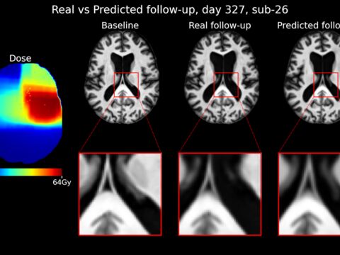 Figuur met MRI-scan, dosis radiotherapie en afbeeldingen die laten zien hoe de hersenen in de tijd veranderen na behandeling met radiotherapie.